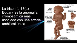 La trisomía 18(sx
Eduar) es la anomalía
cromosómica más
asociada con una arteria
umbilical única
 