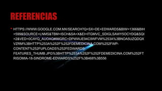 REFERENCIAS
• HTTPS://WWW.GOOGLE.COM.MX/SEARCH?Q=SX+DE+EDWARDS&BIW=1366&BIH
=599&SOURCE=LNMS&TBM=ISCH&SA=X&EI=ITGMVC_SDIGLSAWY5OCYDQ&SQI
=2&VED=0CAYQ_AUOAQ#IMGRC=DPWWJE94C9WFVM%253A%3BNOA5UZQDQX
VZRM%3BHTTP%253A%252F%252FDEMEDICINA.COM%252FWP-
CONTENT%252FUPLOADS%252FEDWARDS-
FEATURES_THUMB.JPG%3BHTTP%253A%252F%252FDEMEDICINA.COM%252FT
RISOMIA-18-SINDROME-EDWARDS%252F%3B468%3B556
TTPS://WWW.YOUTUBE.COM/WATCH?V=UXJKR1J
 