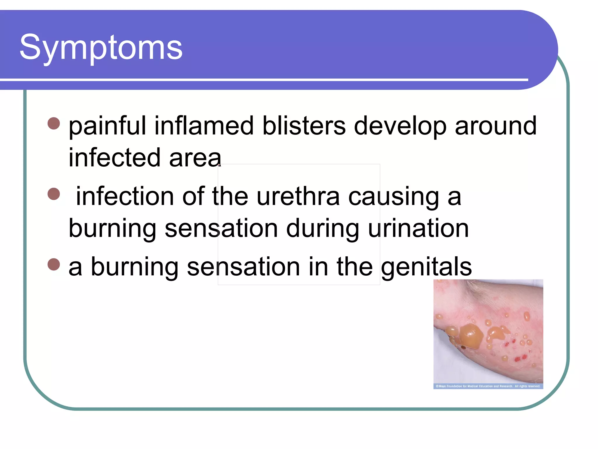 Herpes | PPT