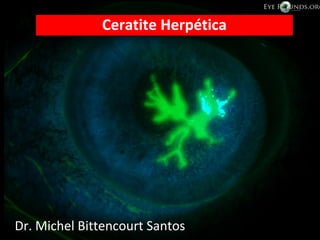 •Dr. Michel Bittencourt Santos
Ceratite Herpética
Dr. Michel Bittencourt Santos
 