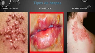 • HERPES GENITAL HERPES ORAL HERPES ZÓSTER
 