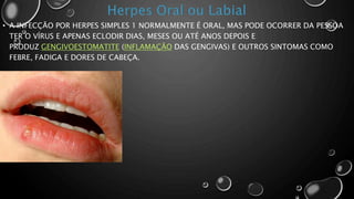 • A INFECÇÃO POR HERPES SIMPLES 1 NORMALMENTE É ORAL, MAS PODE OCORRER DA PESSOA
TER O VÍRUS E APENAS ECLODIR DIAS, MESES OU ATÉ ANOS DEPOIS E
PRODUZ GENGIVOESTOMATITE (INFLAMAÇÃO DAS GENGIVAS) E OUTROS SINTOMAS COMO
FEBRE, FADIGA E DORES DE CABEÇA.
 
