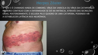 • O TIPO 3 É CHAMADO AINDA DE COBREIRO, VÍRUS DA VARICELA OU VÍRUS DA CATAPORA. O
PRIMEIRO CONTÁGIO COM A ENFERMIDADE SE DÁ NA INFÂNCIA, ATRAVÉS DAS SECREÇÕES
ORAIS, POSTERIORMENTE, É SEGUIDA PELO QUADRO DE UMA CATAPORA, PODENDO VIR
A ESTABELECER LATÊNCIA NOS NEURÔNIOS.
 