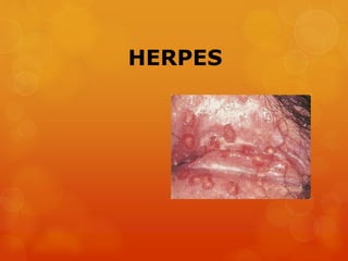 HERPES
 