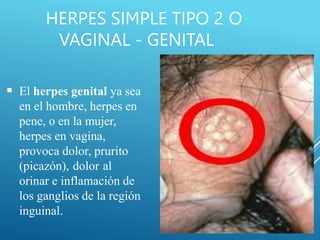 HERPES SIMPLE TIPO 2 O
VAGINAL - GENITAL
■ El herpes genital ya sea
en el hombre, herpes en
pene, o en la mujer,
herpes en vagina,
provoca dolor, prurito
(picazón), dolor al
orinar e inflamación de
los ganglios de la región
inguinal.
 