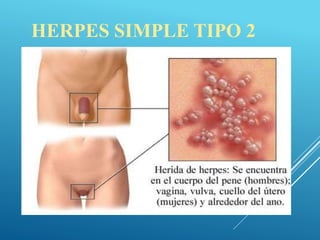 HERPES SIMPLE TIPO 2
 