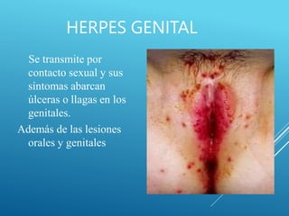 HERPES GENITAL
Se transmite por
contacto sexual y sus
síntomas abarcan
úlceras o llagas en los
genitales.
Además de las lesiones
orales y genitales
 