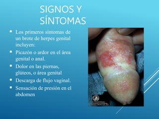 SIGNOS Y
SÍNTOMAS
■
■
■
■
■
Los primeros síntomas de
un brote de herpes genital
incluyen:
Picazón o ardor en el área
genital o anal.
Dolor en las piernas,
glúteos, o área genital
Descarga de flujo vaginal.
Sensación de presión en el
abdomen
 