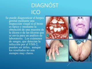 DIAGNÓST
ICO
Se puede diagnosticar el herpes
genital mediante una
inspección visual si el brote
es típico y mediante la
obtención de una muestra de
la úlcera o de las úlceras que
se envía para un análisis de
laboratorio. Los exámenes
de sangre, que detectan la
infección por el VSH-2,
pueden ser útiles, aunque
los resultados no son
siempre muy claros.
 