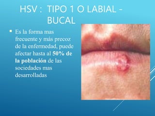 HSV : TIPO 1 O LABIAL -
BUCAL
■ Es la forma mas
frecuente y más precoz
de la enfermedad, puede
afectar hasta al 50% de
la población de las
sociedades mas
desarrolladas
 