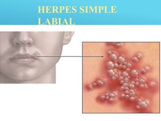 HERPES SIMPLE
LABIAL
 