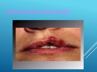 GINGIVOESTOMATITIS
 