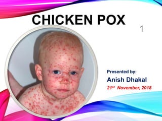CHICKEN POX
Presented by:
Anish Dhakal
21st November, 2018
1
 