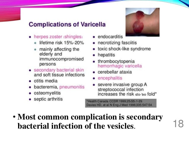 Chicken Pox Varicella Herpes Zoster