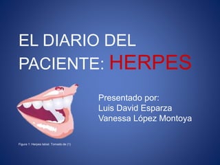 EL DIARIO DEL 
PACIENTE: HERPES 
Presentado por: 
Luis David Esparza 
Vanessa López Montoya 
Figura 1: Herpes labial. Tomado de (1) 
 