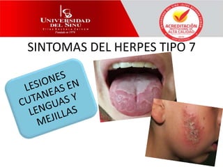SINTOMAS DEL HERPES TIPO 7
 