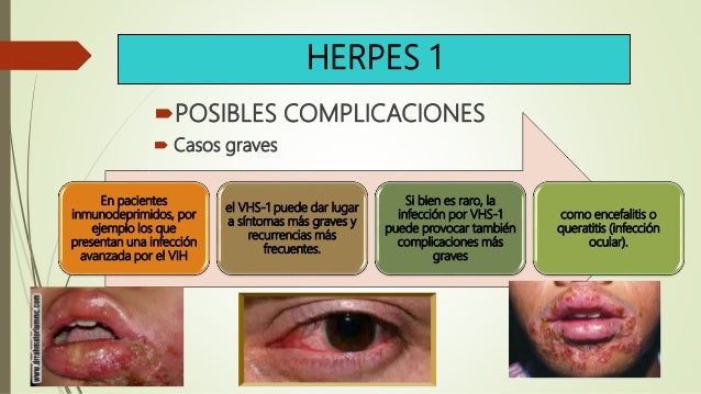 complicaciones herpes simple complicaciones herpes simple