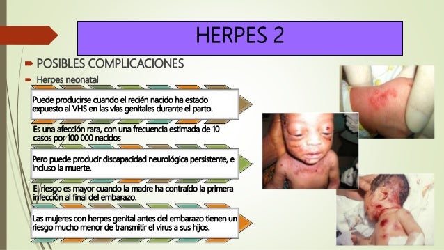 Herpes 1 Y 2