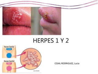 HERPES 1 Y 2
COJAL RODRIGUEZ, Lucia
 
