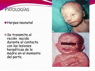 PATOLOGÍAS
⚫Herpes neonatal
Se transmite al
recién nacido
durante el contacto
con las lesiones
herpéticas de la
madre en el momento
del parto.
 