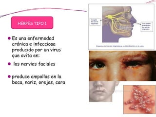 HERPES TIPO 1
Periodo de latencia
⚫ Es una enfermedad
crónica e infecciosa
producido por un virus
que avita en:
⚫ los nervios faciales
⚫ produce ampollas en la
boca, nariz, orejas, cara
 