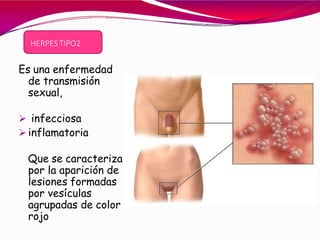 HERPES TIPO2
regióngenital
Es una enfermedad
de transmisión
sexual,
 infecciosa
 inflamatoria
Que se caracteriza
por la aparición de
lesiones formadas
por vesículas
agrupadas de color
rojo
 