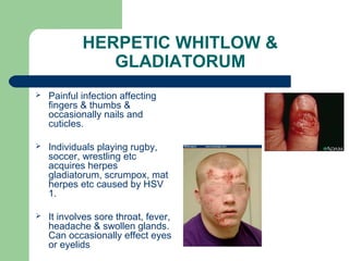 HERPETIC WHITLOW & 
GLADIATORUM 
 Painful infection affecting 
fingers & thumbs & 
occasionally nails and 
cuticles. 
 Individuals playing rugby, 
soccer, wrestling etc 
acquires herpes 
gladiatorum, scrumpox, mat 
herpes etc caused by HSV 
1. 
 It involves sore throat, fever, 
headache & swollen glands. 
Can occasionally effect eyes 
or eyelids 
 