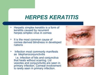 HERPES KERATITIS 
 Herpetic simplex keratitis is a form of 
keratitis caused by recurrent 
herpes simplex virus in cornea 
 It is the most common cause of 
cornea derived blindness in developed 
nations 
 Infection most commonly manifests 
as blepharoconjunctivitis 
i.e. infection of lids and conjunctiva 
that heals without scarring. Lid 
vesicles and conjunctivitis are seen in 
primary infection. Corneal involvement 
is rarely seen in primary infection. 
 