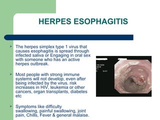 HERPES ESOPHAGITIS 
 The herpes simplex type 1 virus that 
causes esophagitis is spread through 
infected saliva or Engaging in oral sex 
with someone who has an active 
herpes outbreak. 
 Most people with strong immune 
systems will not develop, even after 
being infected by the virus. risk 
increases in HIV, leukemia or other 
cancers, organ transplants, diabetes 
etc 
 Symptoms like difficulty 
swallowing, painful swallowing, joint 
pain, Chills, Fever & general malaise. 
 