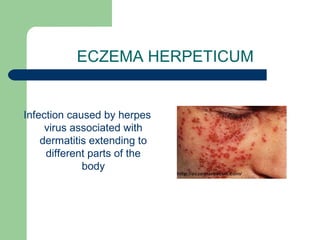 ECZEMA HERPETICUM 
Infection caused by herpes 
virus associated with 
dermatitis extending to 
different parts of the 
body 
 
