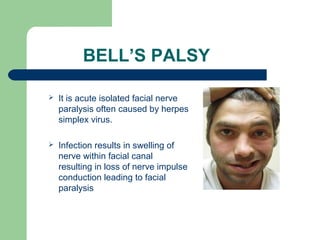 BELL’S PALSY 
 It is acute isolated facial nerve 
paralysis often caused by herpes 
simplex virus. 
 Infection results in swelling of 
nerve within facial canal 
resulting in loss of nerve impulse 
conduction leading to facial 
paralysis 
 