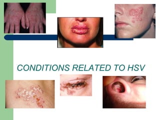 CONDITIONS RELATED TO HSV 
 