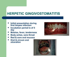 HERPETIC GINGIVOSTOMATITIS 
 Initial presentation during 
first herpes infection 
 Incubation period is of 5 
day 
 Malaise, fever, tenderness 
 Body aches, sore throat 
 Red & sore oral mucosa 
 Oral & circum oral 
ulceration 
 