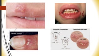 Morbiliform Rash Cmv Herpes and cmv | PPTX