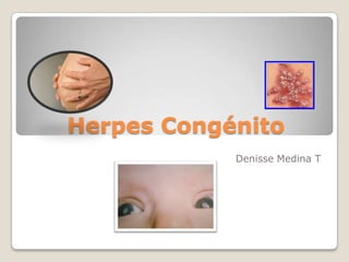Herpes Congénito
Denisse Medina T
 