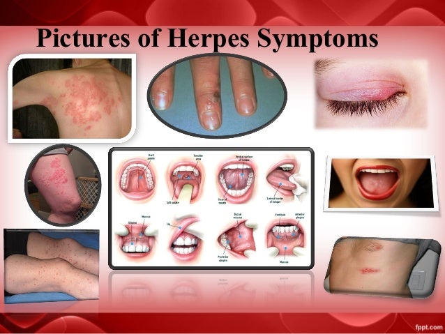 Symptoms herpes genital Herpes Symptoms