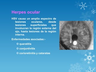 Herpes ocular
HSV causa un amplio espectro de
lesiones
oculares,
desde
lesiones
superficiales
que
involucran la región externa del
ojo, hasta lesiones de la región
interna.
Enfermedades asociadas: queratitis
 conjuntivitis
 corioretinitis y cataratas

 