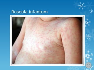 Roseola infantum

 