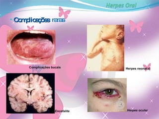 Complicações : raras Complicações   bucais Herpes neonatal Herpes ocular Encefalite 