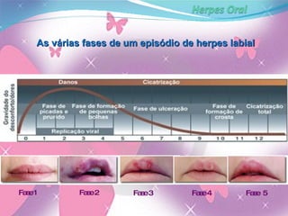 Fase 1 Fase 2 Fase 3 Fase 4 Fase  5 As  várias fases de um episódio de herpes labial 