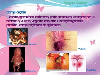 Complicações:  aborto espontâneo, natimorto, parto prematuro, infecções peri e neonatais, vulvite, vaginite, cervicite, ulcerações genitais, proctite,  complicações neurológicas etc. Aborto Prostatite Vulvite Natimorto 