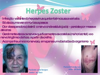 Infecção:  variante do herpesvírus que também causa a varicela Só ataca uma vez e imuniza a pessoa Dor desesperadora (destrói o nervo onde está alojado) - persiste por meses e até anos  Geralmente ataca os nervos que ficam entre as costelas (na horizontal) e o nervo trigêmeo da face, a partir da orelha Acompanha um ramo nervoso, em apenas um dos lados do organismo Paciente com herpes zoster  na face Paciente com herpes  zoster no tórax 