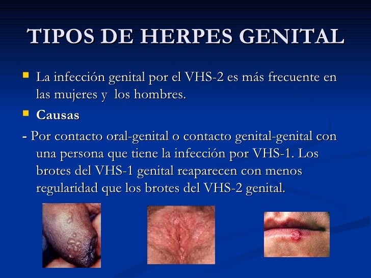 STD Facts - Genital Herpes (Detailed version)