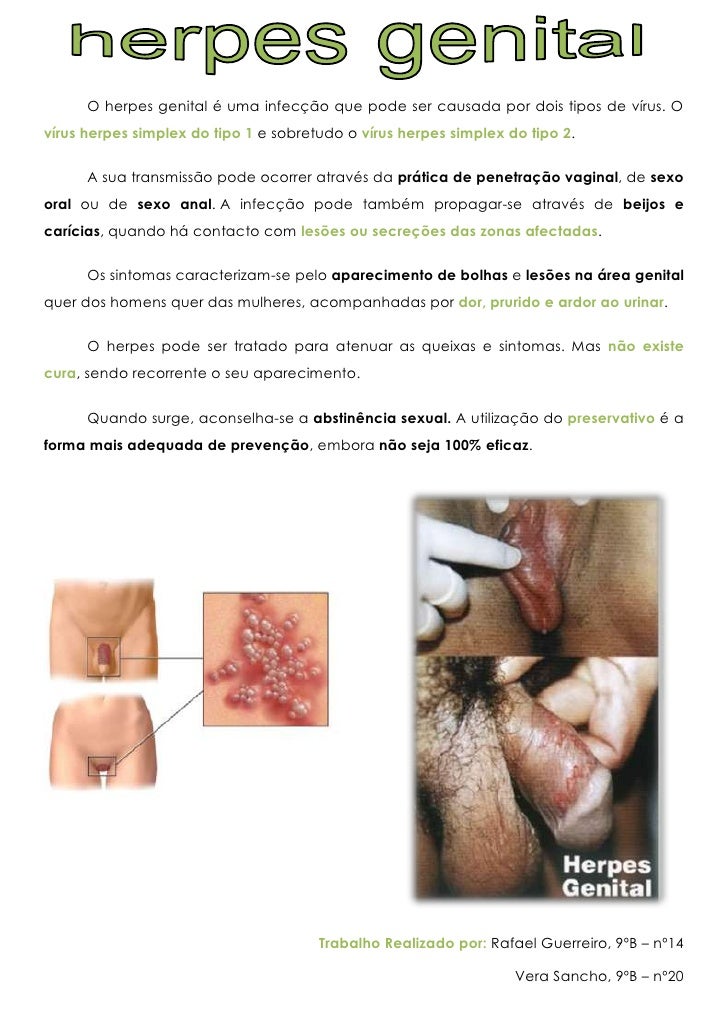 texas-get-genital-herpes-from-oral-sex-teachers
