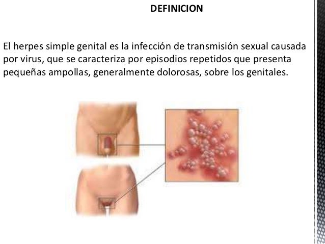 La crema contra el hongo sobre el miembro