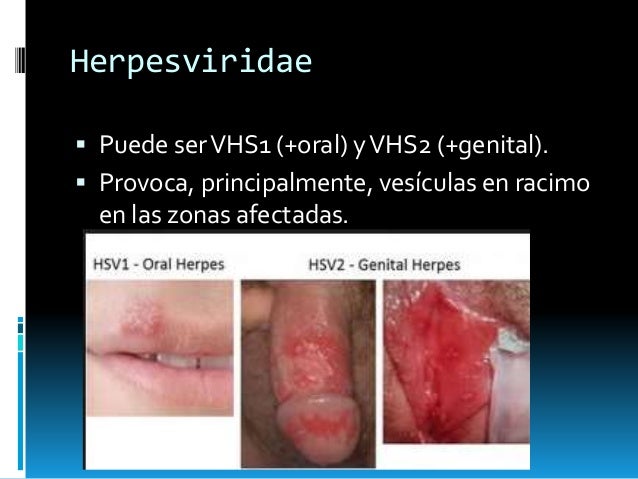 como son los herpes genitales fotos