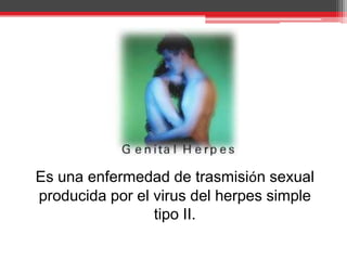 Es una enfermedad de trasmisión sexual producida por el virus del herpes simple tipo II.