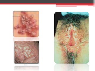 Puede reactivarse a través de úlceras genitales recurrentes.CUADRO CLÍNICOIncubación 3 a 7 días