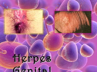 Herpes Genital  