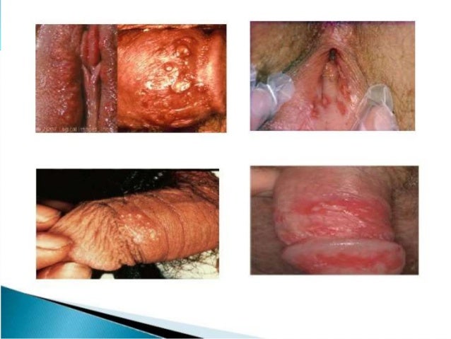 Herpes Genital Gustavo Gomez 6to Naturales